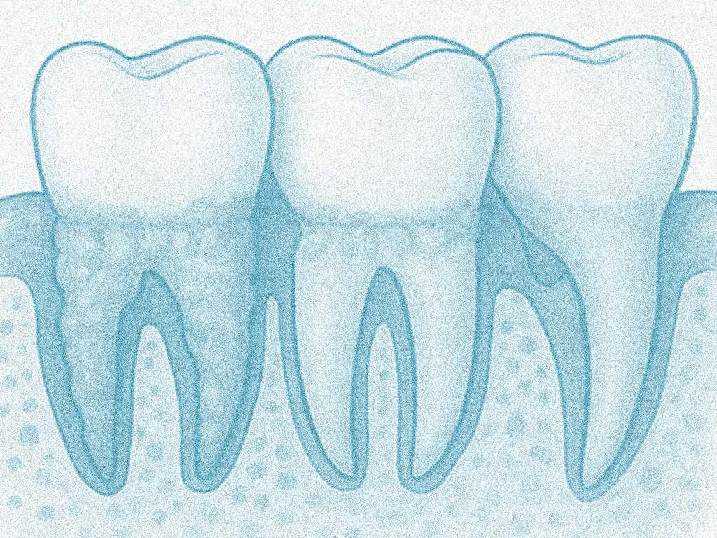 Illustration médicale montrant les étapes du traitement de la maladie parodontale chez Gumex à Montréal, Québec.